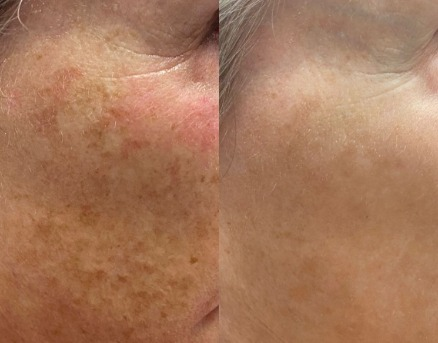 Antes e depois — Tratamento de manchas
