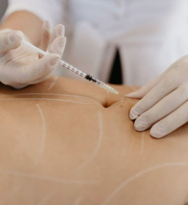 Hidrolipoclasia não aspirativa