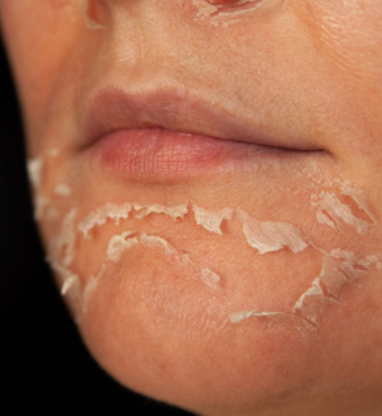 Peeling Químico
