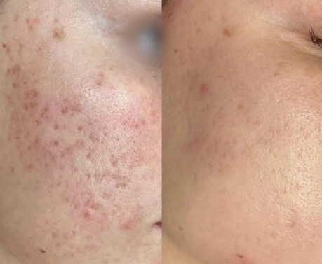 Antes e depois — Tratamento para Acne