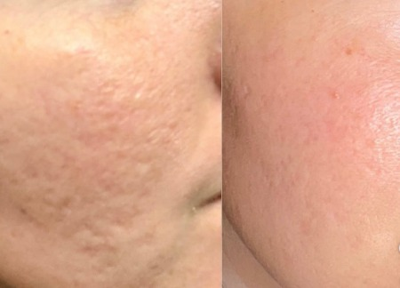Antes e depois — Tratamento para cicatriz de Acne
