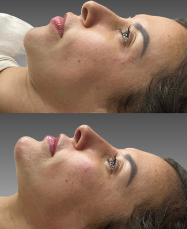 Preenchimento Facial